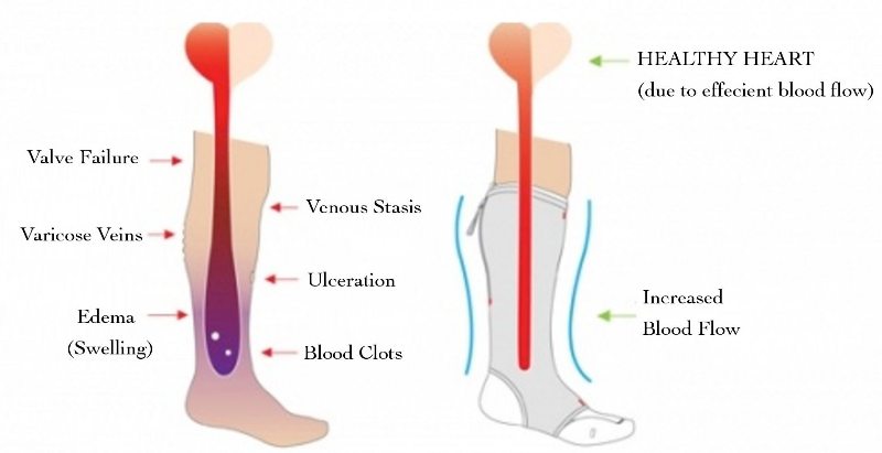 Compression Stockings for Varicose Veins: Which Type Is Best for You?