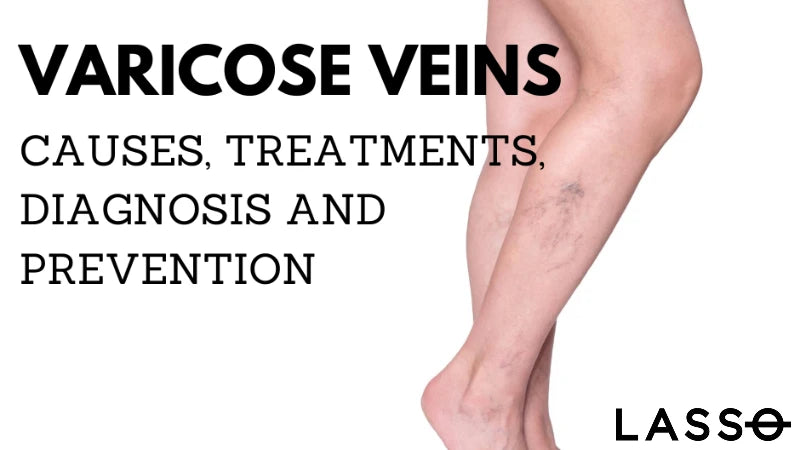 How to Prevent Varicose Veins: Causes, Prevention, and Treatment